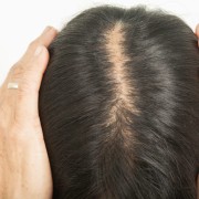 薄毛の”リスク”ご存知ですか?